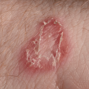 fungos leveduras sintomas de fungos diagnóstico de fungos